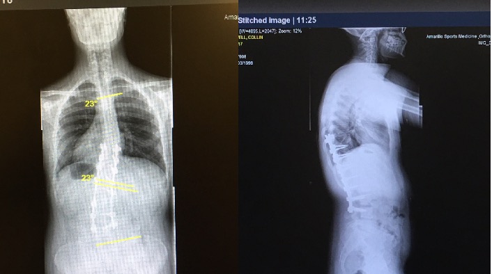 Not your Average Summer Break: Student undergoes life-changing back surgery